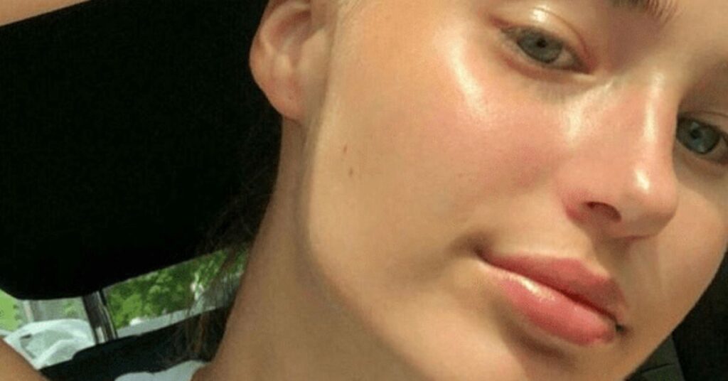 Korean Skincare for Acne