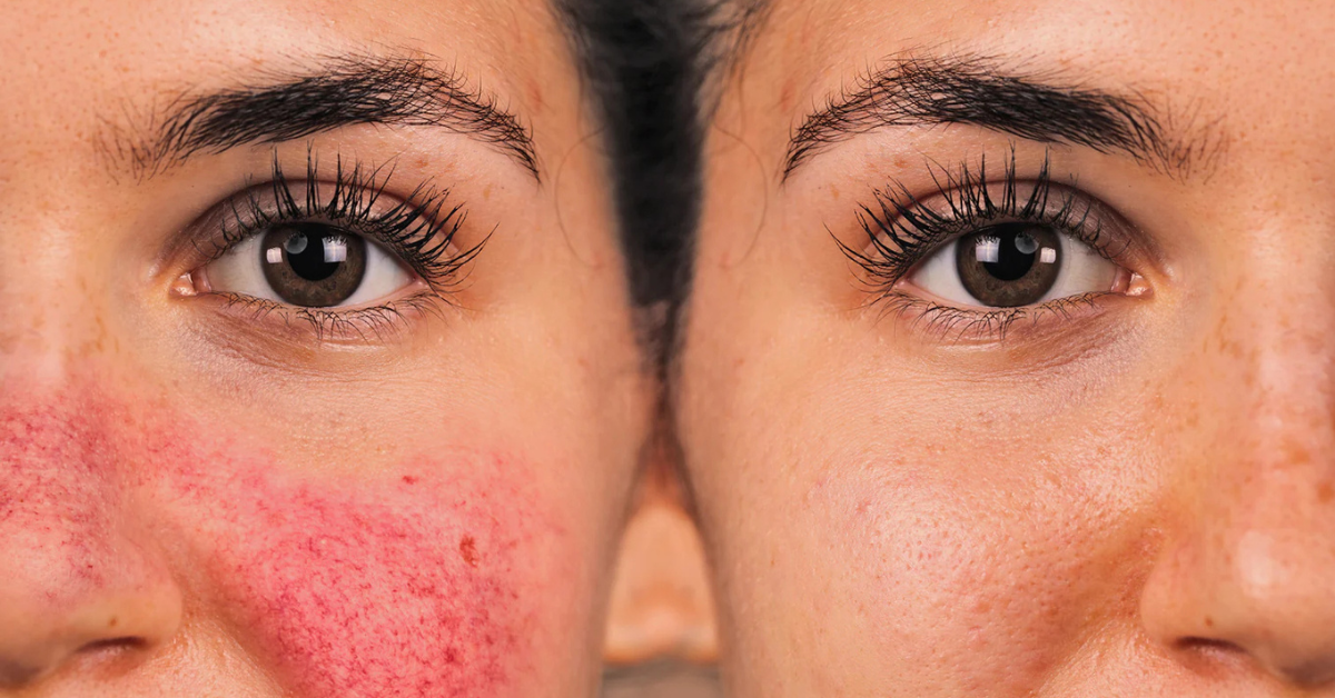 Gentle Skincare for Rosacea: Best Soothing Routine for Sensitive Skin