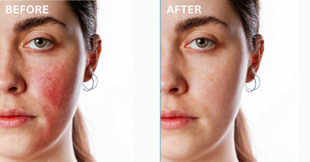 Skincare for Redness: Calm and Soothe Your Skin in Every Season