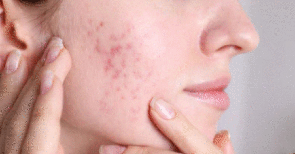 Korean Skincare for Acne Scars